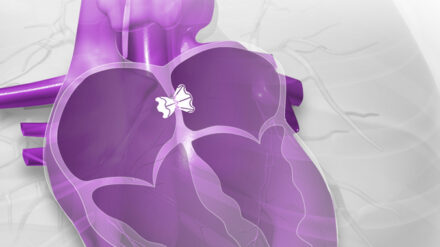 Das Implantat der israelischen Firma V-Wave ist hier weiß eingezeichnet und soll das Herz entlasten